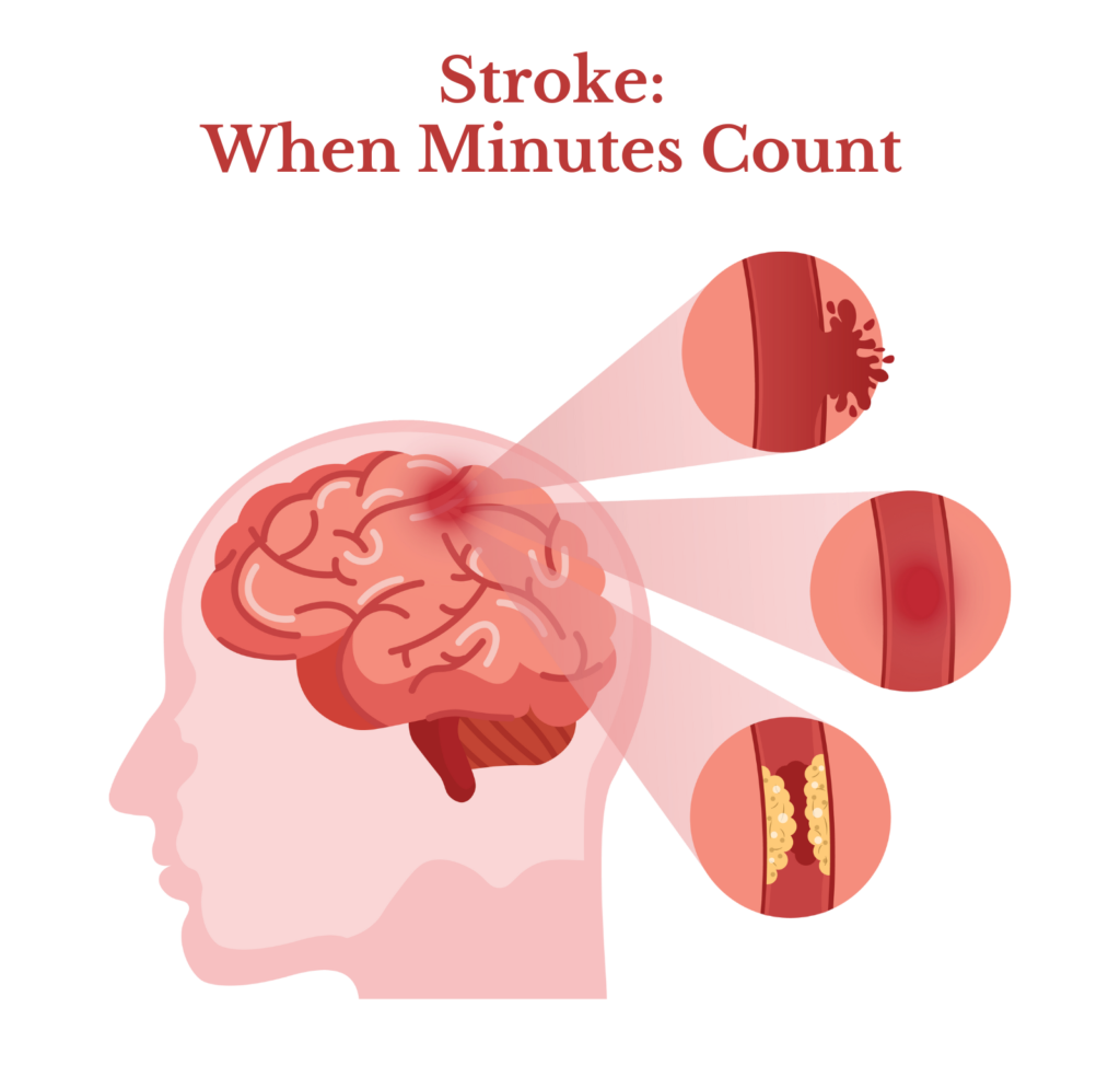A picture of someone with stroke